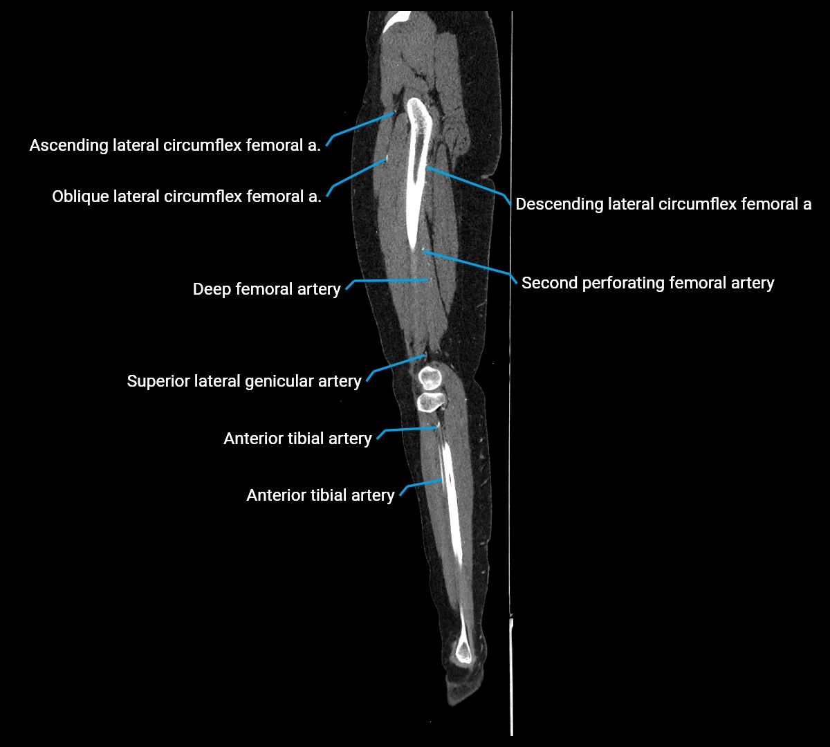 CTA lower limb sagittal cross sectional anatomy labelled image _55 (3).webp